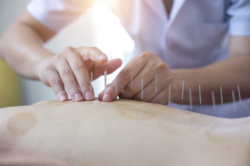 What Techniques Are Used In Acupuncture?